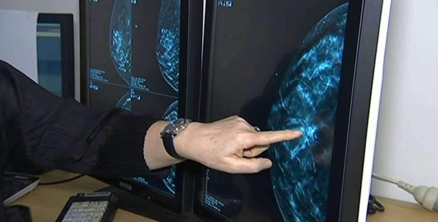 Queensland biopsy mix-up causes two women to be given wrong cancer diagnoses